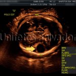 Aneurisma da Veia de Galeno observado pelo ultrassom obstétrico
