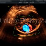 Aneurisma da Veia de Galeno observado pelo ultrassom obstétrico com doppler