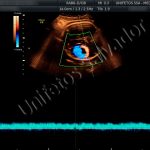 Aneurisma da Veia de Galeno observado pelo ultrassom obstétrico com doppler