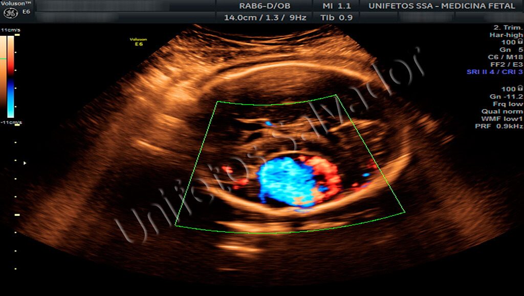 Aneurisma da veia de Galeno na ultrassonografia obstétrica com doppler